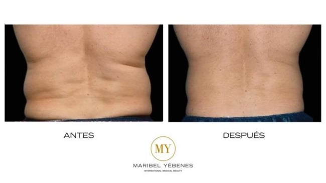 ANTES Y DESPUÉS MY METHOD