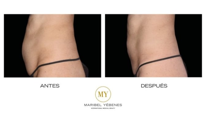ANTES Y DESPUÉS MY METHOD