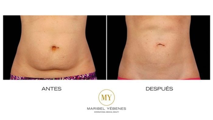 ANTES Y DESPUÉS MY METHOD