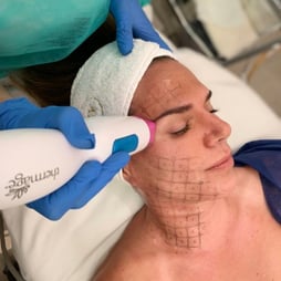 THERMAGE FLX