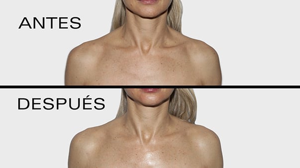 Tratamiento Peeling Japonés Antes y despues_web